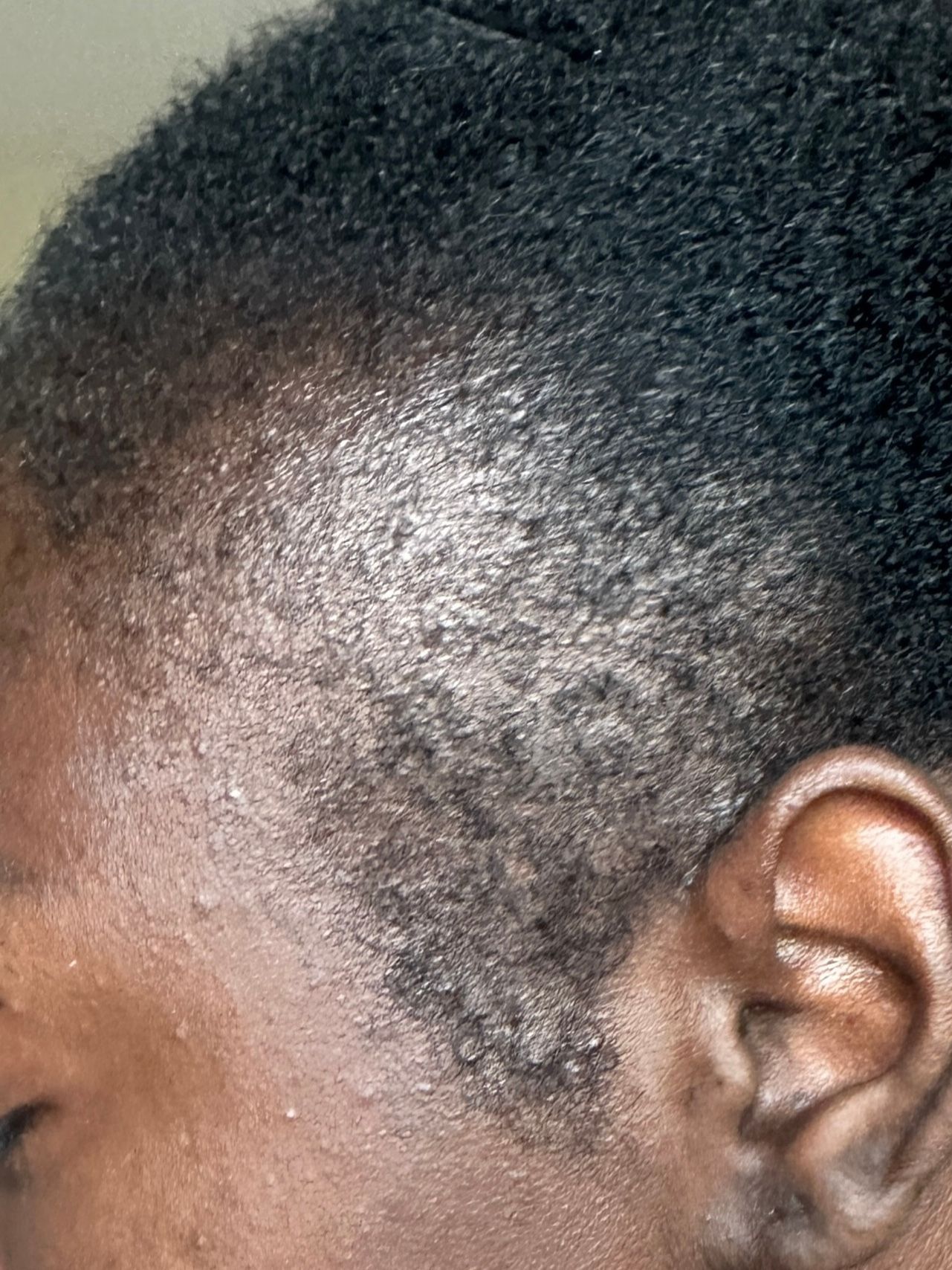 Closeup on traction alopecia hair loss on a Black woman