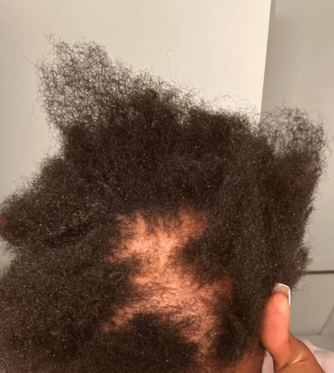Closeup of patchy hair loss from traction alopecia.